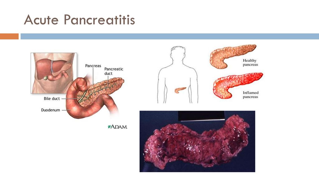 Se puede repetir una pancreatitis